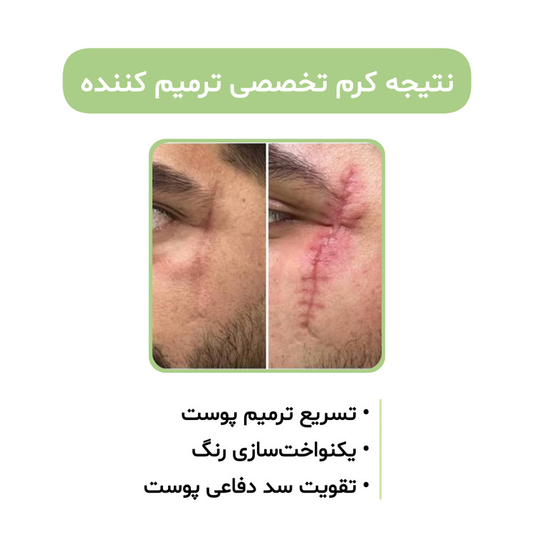 کرم بیوممتیک ۵ کاره گاتیو کلاژن ساز ضداسکار ترمیم کننده