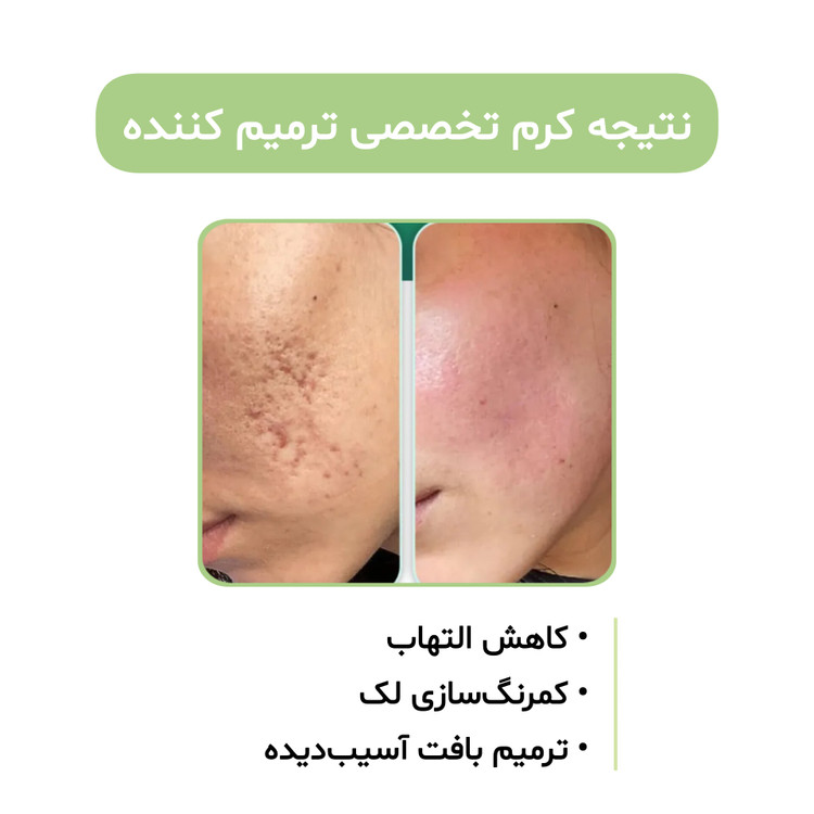 کرم بیوممتیک ۵ کاره گاتیو کلاژن ساز ضداسکار ترمیم کننده