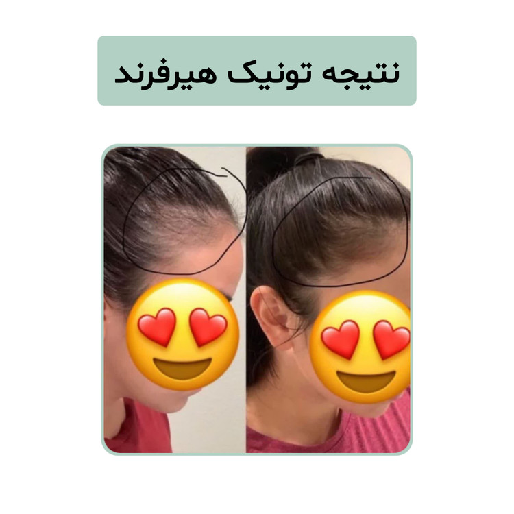 تونیک گیاهی تقویت مو هیرفرند ۳۰۰ میل ضد ریزش ضخیمکننده و رفع خارش سر