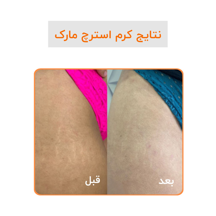 کرم رفع ترک گاتیو استرچ مارک ترمیم خطوط بارداری و لاغری