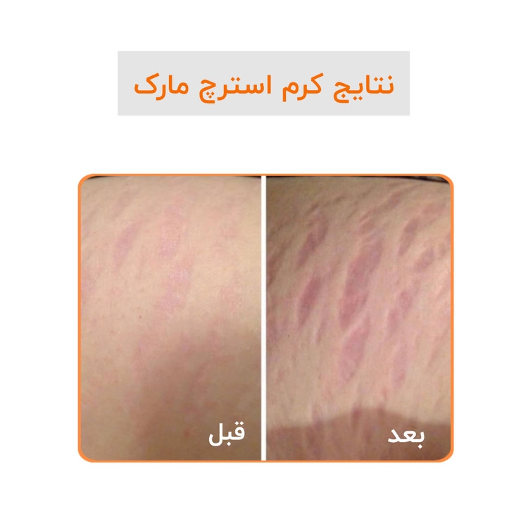 کرم رفع ترک گاتیو استرچ مارک ترمیم خطوط بارداری و لاغری