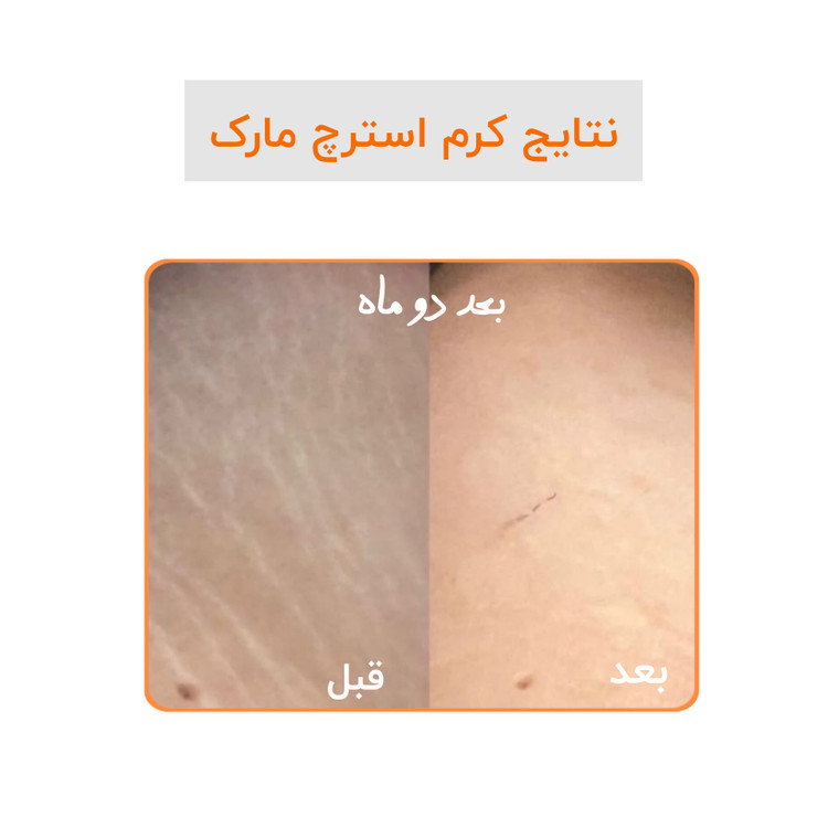 کرم رفع ترک گاتیو استرچ مارک ترمیم خطوط بارداری و لاغری