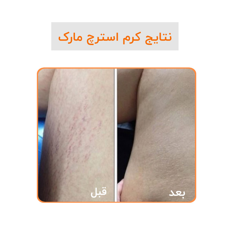 کرم رفع ترک گاتیو استرچ مارک ترمیم خطوط بارداری و لاغری