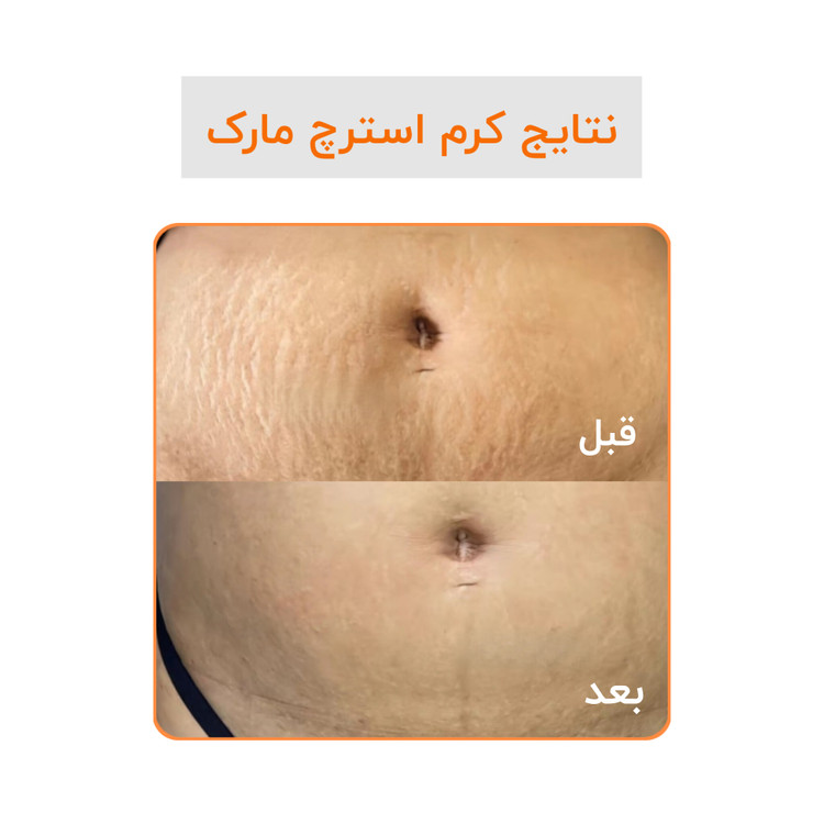 کرم رفع ترک گاتیو استرچ مارک ترمیم خطوط بارداری و لاغری