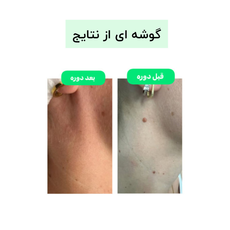 پک تخصصی ۴۰ روزه زگیل تناسلی و پاکسازی ریشهای HPV