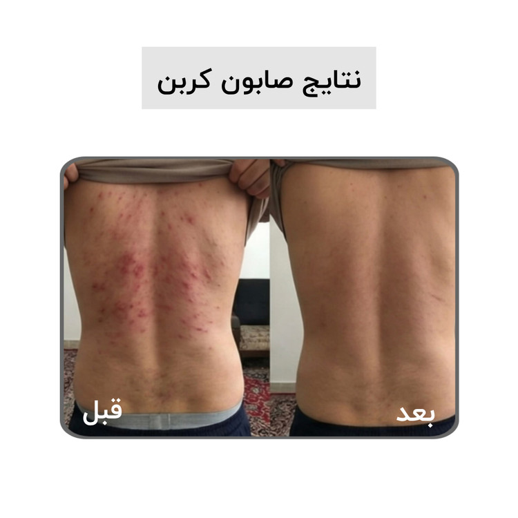صابون بیوممتیک کربن اکتیو بیز ضد جوش ضد لک روشن کننده