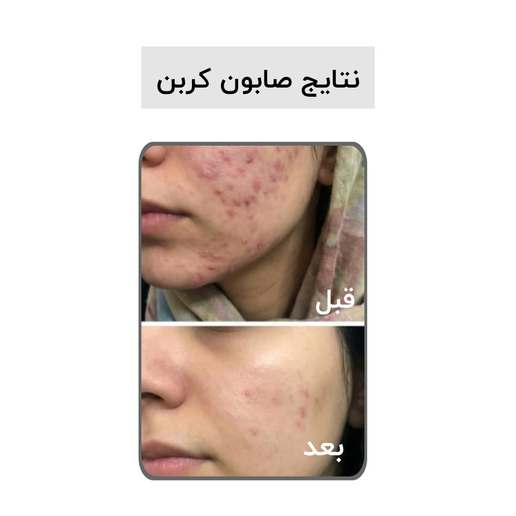 صابون بیوممتیک کربن اکتیو بیز ضد جوش ضد لک روشن کننده