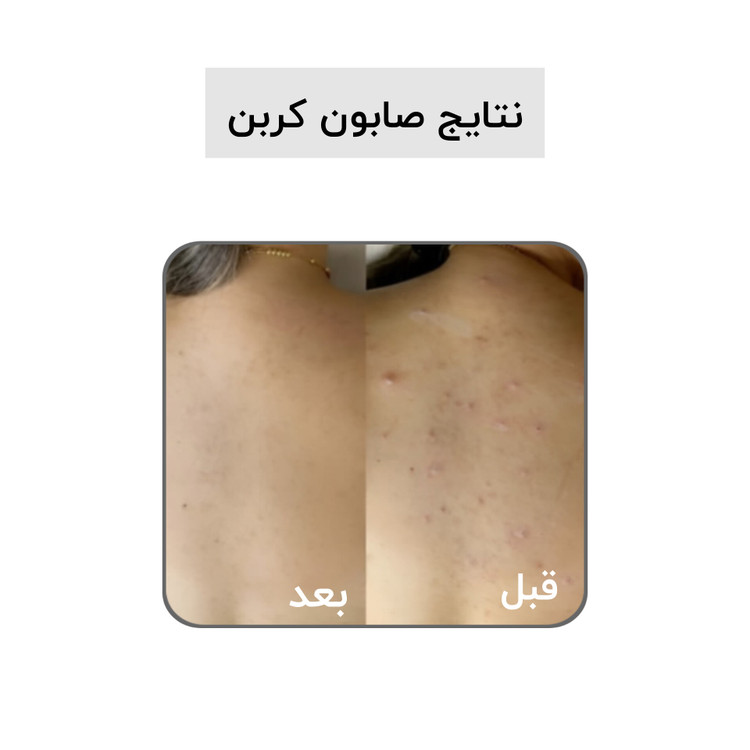 صابون بیوممتیک کربن اکتیو بیز ضد جوش ضد لک روشن کننده