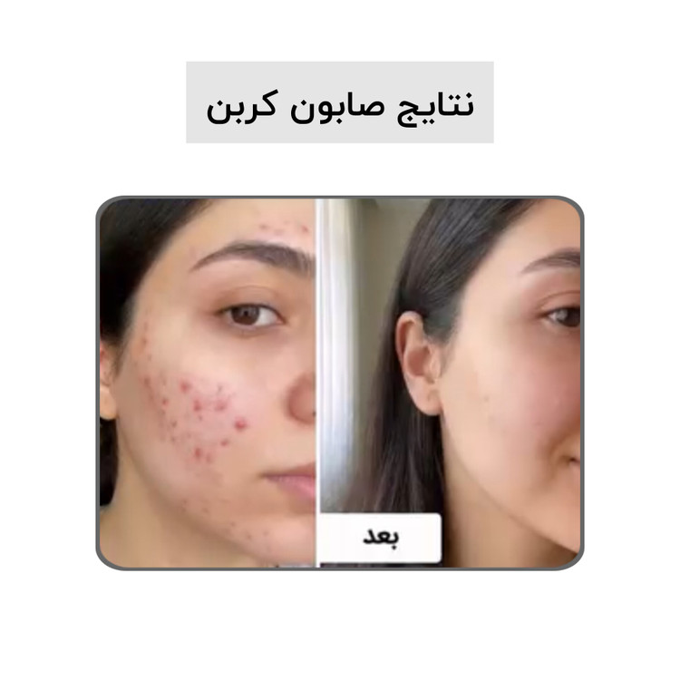 صابون بیوممتیک کربن اکتیو بیز ضد جوش ضد لک روشن کننده